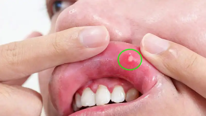 Kanserin Sessiz Uyarıları: Dilini Kaybeden Adamın Hikayesi
