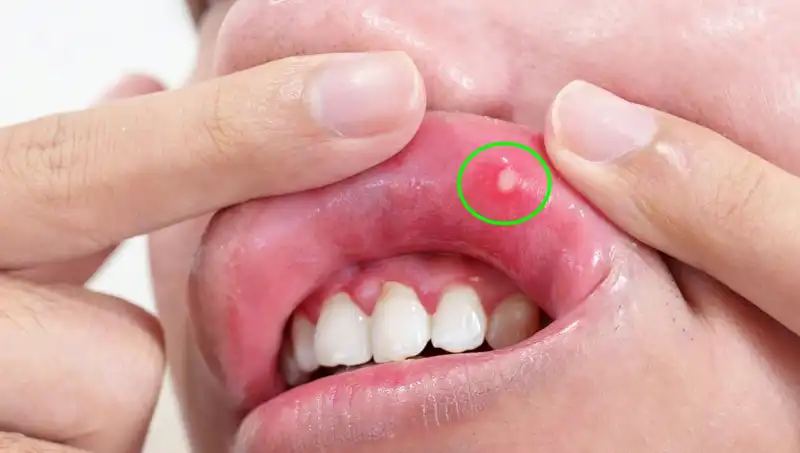 B Vitamini Eksikliği: Belirtiler ve Vücudunuz Üzerindeki Etkileri